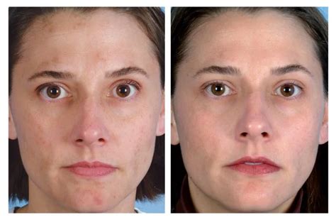 Dermabrasion Before And After Acne Scars Skinplus