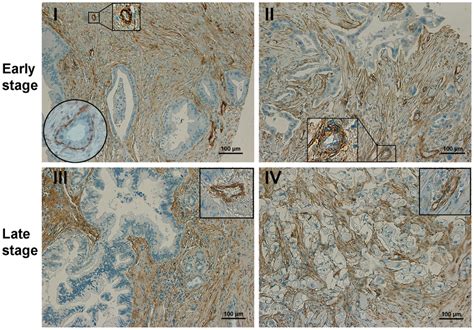 Research into pdac stroma is rich with potential for improving treatment of this lethal tumor. Overexpression of CD90 in the stroma of pancreatic ...