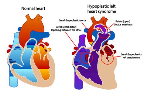 Norwood Procedure