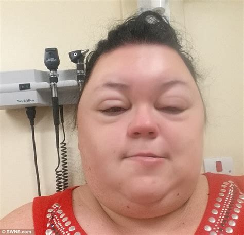 Woman Left Looking Like A Monster After Her Face Swelled Daily Mail