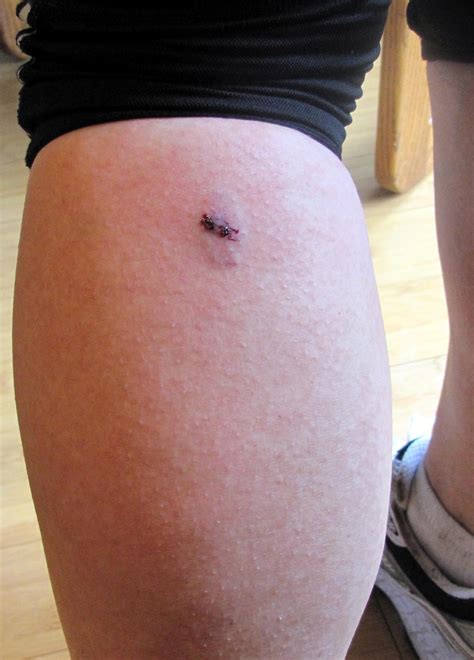 Puncture wounds, nerve damage, and infections can lead to significant medical expenses, lost wages, and pain and suffering. dog bite infection pictures - pictures, photos