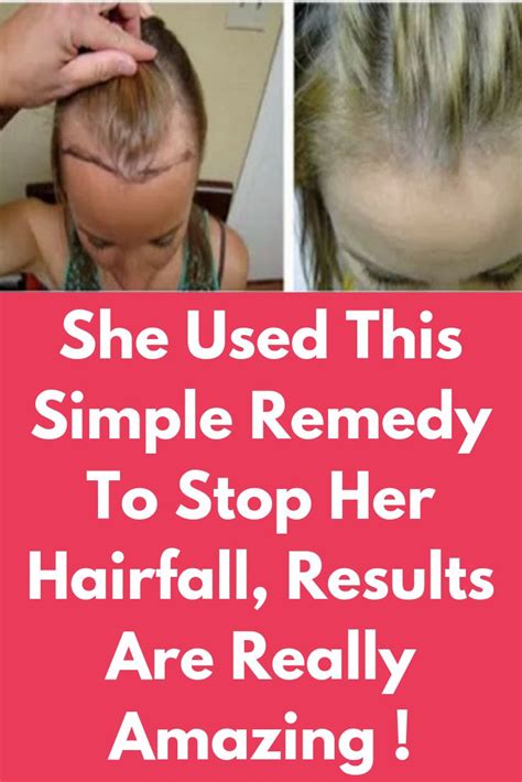 She Used This Simple Remedy To Stop Her Hairfall Results Are Really