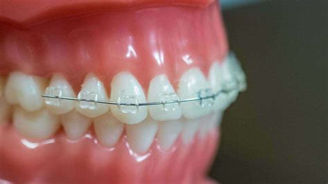 Clear Brackets With Colored Bands