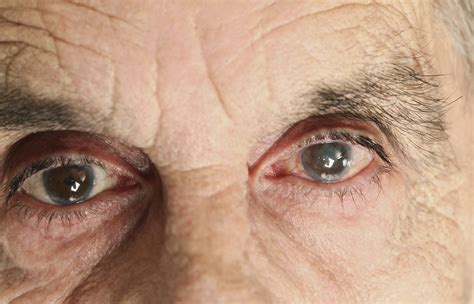 Болезнь альцгеймера и глаукома фото презентация