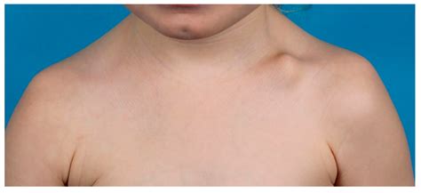 Children Free Full Text Pediatric Clavicle Fractures And Congenital