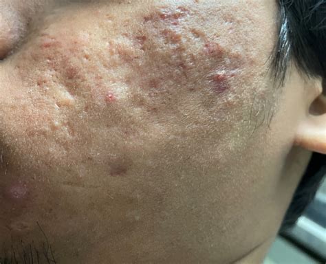 Bad Acne Scarring Need Help Pls Scar Treatments Forum