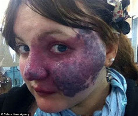 California Woman Whos Has Port Wine Stain Turns Meme About Her Into