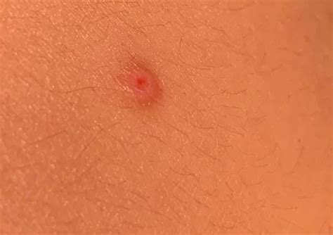 Have Had This Bump On My Back For A While Now I Cant Help But Worry