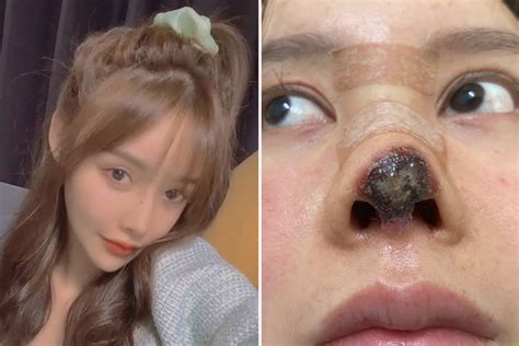 Pretty Chinese Actress Left With Rotting Deformed Nose
