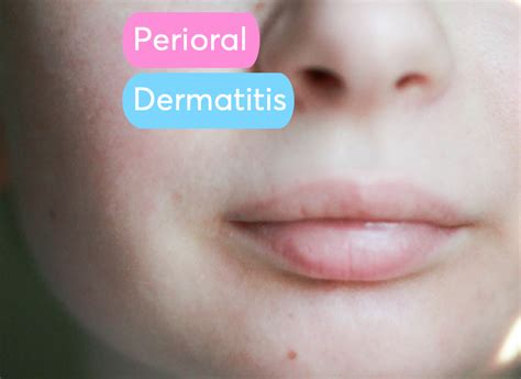 Perioral Dermatitis Lips