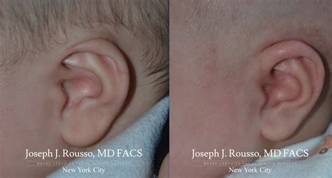 New York Earwell Infant Ear Correction System Nyc Baby Ear Deformity