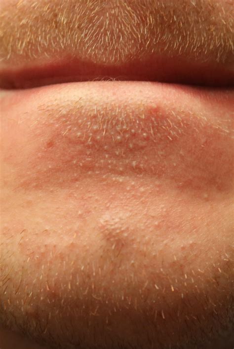 White Bumps Below My Lower Lip And Around My Chin Avent Budged In