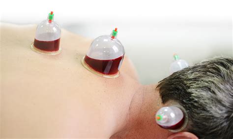 How To Detoxify Yourself Using Chinese Cupping Therapy Procaffenation
