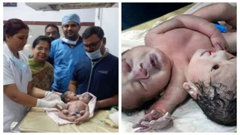 photo woman gives birth to rare conjoined twins with two heads three arms and shared organs