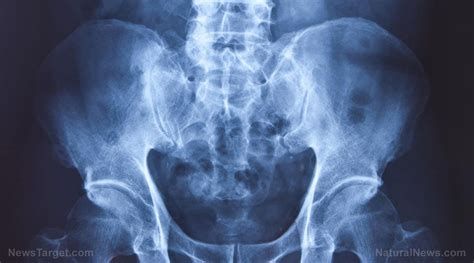 Cobalt In Hip Replacement Parts Found To Cause Alzheimers Disease Via