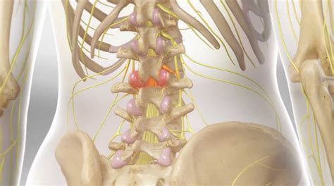 Nerve Ablations Or Radiofrequency Rhizotomy Des Moines Iowa