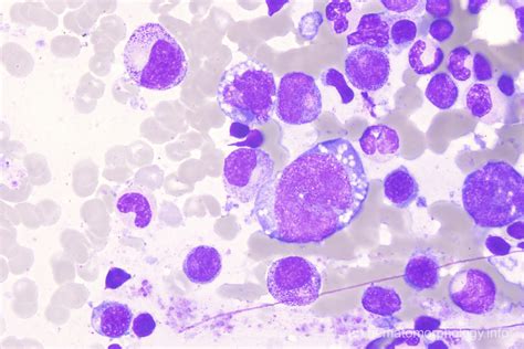 Diffuse Large B Cell Lymphoma Dlbcl Hematomorphology A Databank