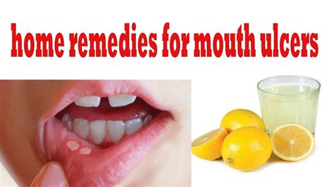 😰 Ulcers In Mouth How To Get Rid Of Mouth Ulcers How To Remove A