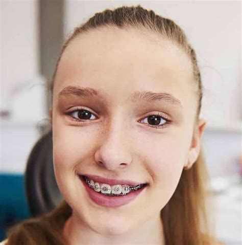What To Expect From Dental Braces My Affordable Dentist Near Me