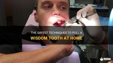 The Safest Techniques To Pull A Wisdom Tooth At Home Medshun
