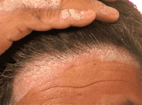Scalp And Hair Disorder Treatment Program Scalp And Hair Loss Therapy