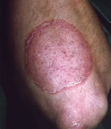 How Accurate Is A Clinical Diagnosis Of Erythema Chronicum Migrans