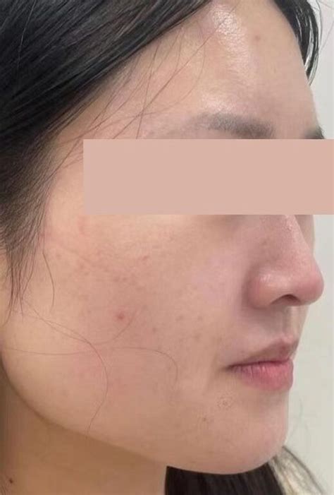 Exceed™ Microneedling 67 Degrees Cosmetic Clinic