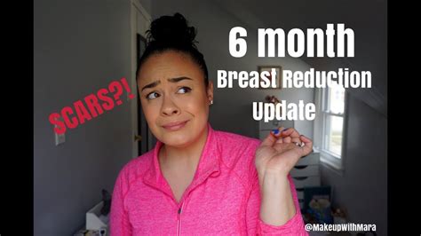 6 Month Post Op Breast Reduction Showing Scars Youtube