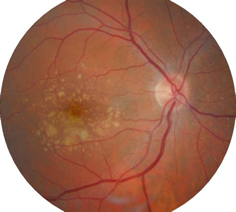 Bay Eye Care — Glaucoma And Retinal Disease
