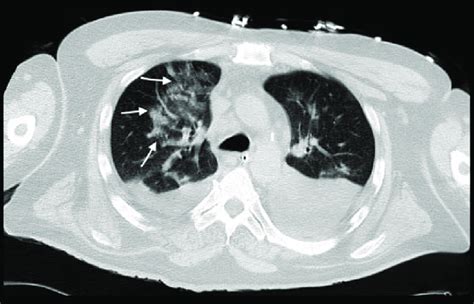 Ct Chest Without Iv Contrast Axial Lung View Suggesting Pulmonary