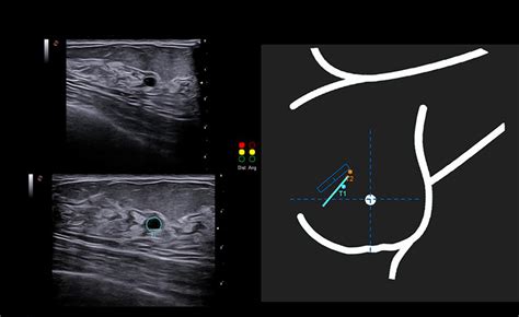 Breastnav™ Breast Ultrasound Advanced Solution Esaote