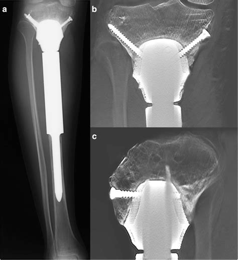 A Anteroposterior Radiograph Of Right Tibia 26 Months After 3d Printed