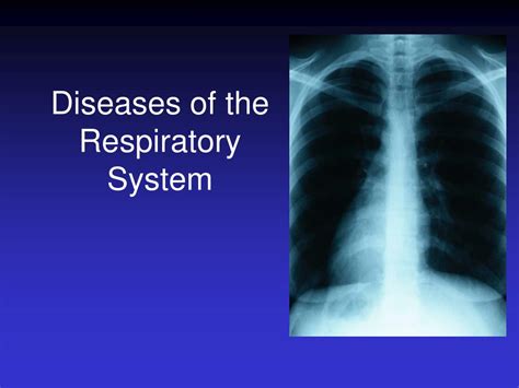 Ppt Diseases Of The Respiratory System Powerpoint Presentation Free