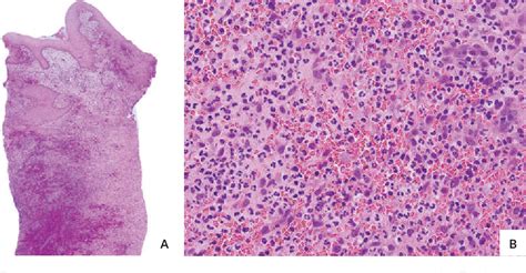 Figure 3 From A Rare Case Of Bullous Pyoderma Gangrenosum In A Patient
