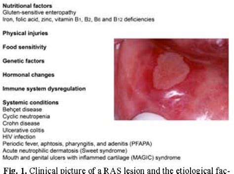Figure 1 From Recurrent Aphthous Stomatitis And Helicobacter Pylori