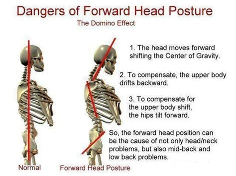 Forward Head Posture
