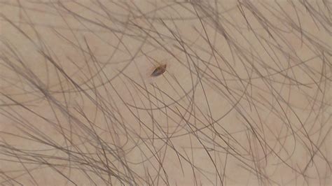 Bed Bugs Vs Fleas Vs Lice See More On Mekanikal Home Tool
