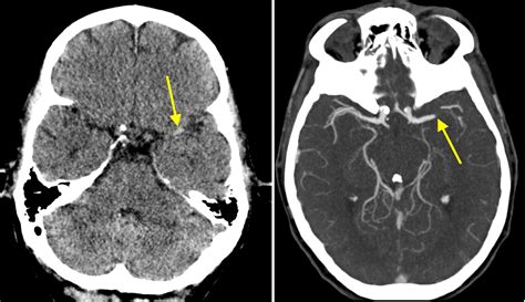 Occluded Middle Cerebral Artery On Ct Angiography Radiology At St