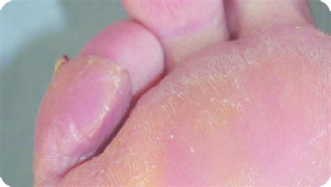Tinea Pedis As A Subtle Plantar Infection Recognised As The Dry