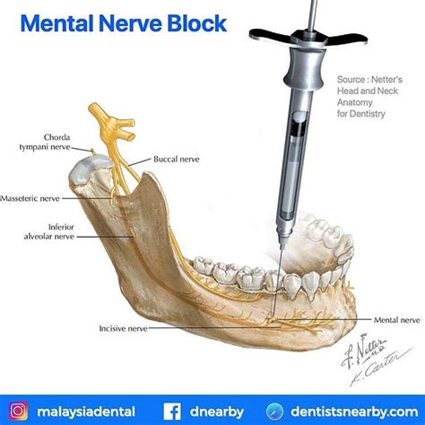 Not So Common Dental Blocks 👉 Akinosi Block⠀ 👉 Gow Gates Injection