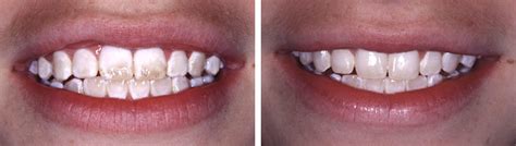 White Spots On Teeth Microabrasion