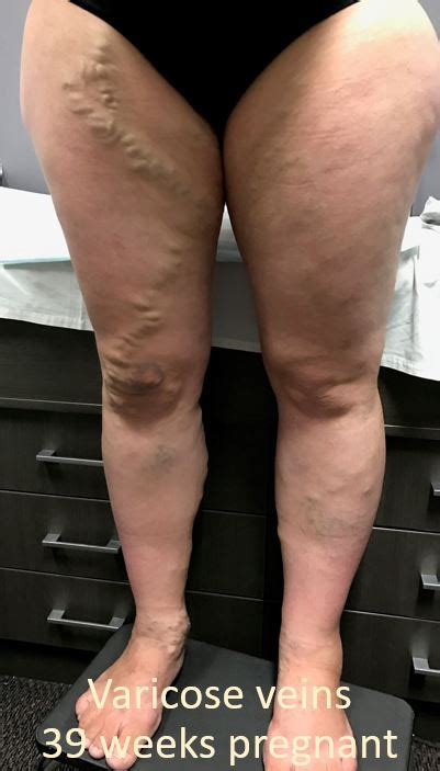 Varicose Veins During Pregnancy Obstetric Excellence Norwest
