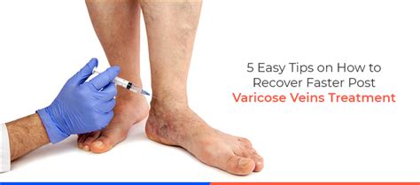 5 Easy Tips On How To Recover Faster Post Varicose Veins Treatment