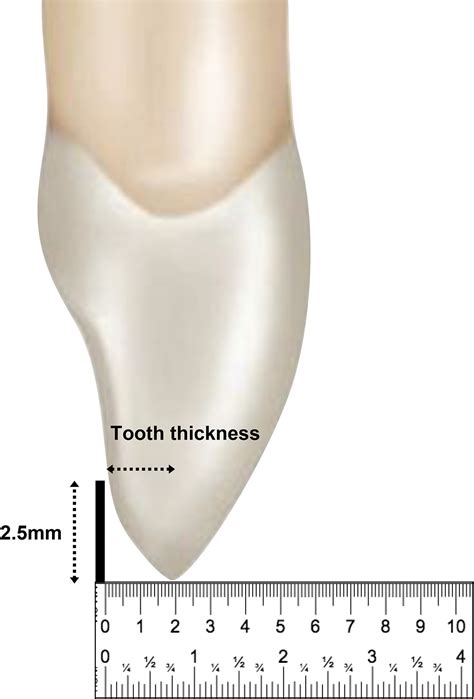 The Influence Of Labiolingual And Mesiodistal Anterior Tooth Dimensions