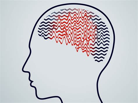 Understanding Epilepsy Causes Symptoms And Treatments My Press Plus
