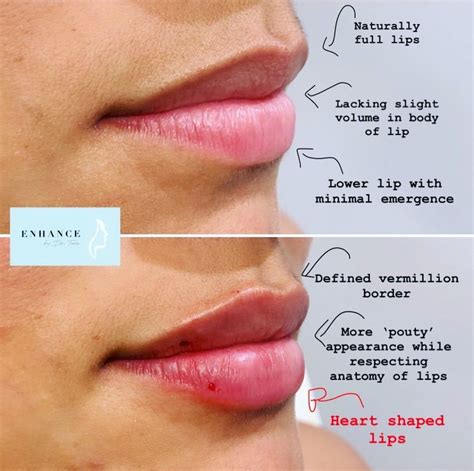 Lip Filler Vs Lip Flip Everything You Need To Know Artofit