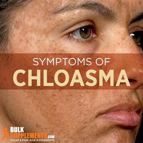 Chloasma Characteristics Causes And Treatment