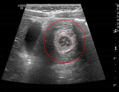Keep Your Eye On The Target Pocus For Intussusception — Brown
