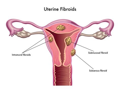 Fibroids Leiomyomas Of The Uterus Obgyn Keith J Reisler Md Plano