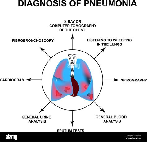 Diagnostik Der Pneumonie Menschlichen Atmungsorgane Welt Pneumonie